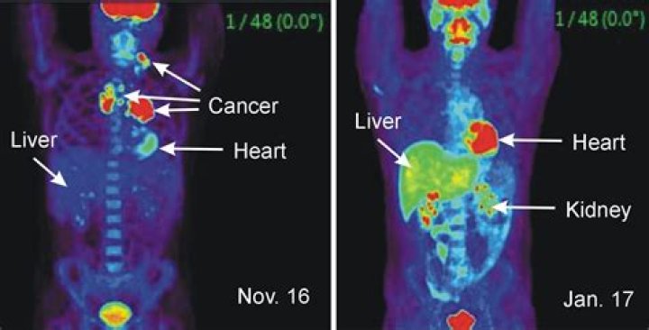 Can radiologist tell if it is cancer?