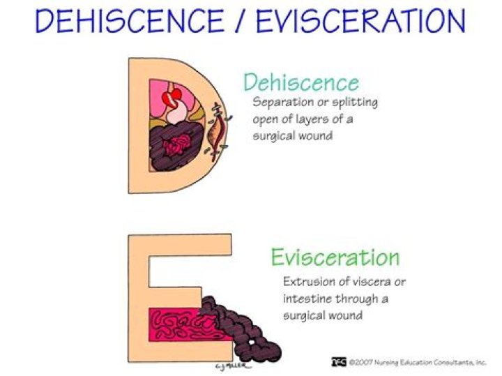 What is the difference between evisceration and dehiscence?